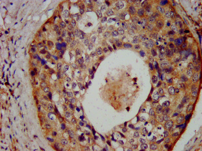 FAP-1 / PTPN13 Antibody - Immunohistochemistry image at a dilution of 1:300 and staining in paraffin-embedded human cervical cancer performed on a Leica BondTM system. After dewaxing and hydration, antigen retrieval was mediated by high pressure in a citrate buffer (pH 6.0) . Section was blocked with 10% normal goat serum 30min at RT. Then primary antibody (1% BSA) was incubated at 4 °C overnight. The primary is detected by a biotinylated secondary antibody and visualized using an HRP conjugated SP system.