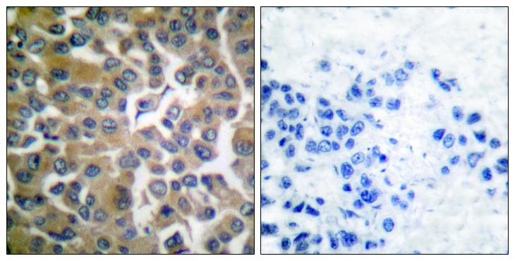 FAP-1 / PTPN13 Antibody - Peptide - + Immunohistochemical analysis of paraffin-embedded human breast carcinoma tissue, using FAP-1 antibody.