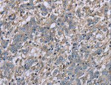 FAP Alpha Antibody - Immunohistochemistry of paraffin-embedded Human colon cancer using FAP Polyclonal Antibody at dilution of 1:30.