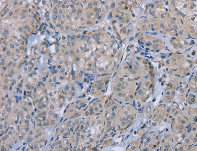 FAP Alpha Antibody - Immunohistochemistry of paraffin-embedded Human thyroid cancer using FAP Polyclonal Antibody at dilution of 1:30.