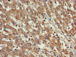 FARP1 / CDEP Antibody - Immunohistochemistry of paraffin-embedded human liver cancer using FARP1 Antibody at dilution of 1:100