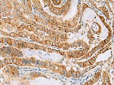 FARP2 / FRG Antibody - Immunohistochemistry of paraffin-embedded Human thyroid cancer tissue  using FARP2 Polyclonal Antibody at dilution of 1:70(×200)