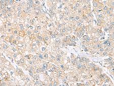 FARP2 / FRG Antibody - Immunohistochemistry of paraffin-embedded Human liver cancer tissue  using FARP2 Polyclonal Antibody at dilution of 1:55(×200)