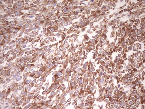 FARSB Antibody - Immunohistochemical staining of paraffin-embedded Human melanoma tissue using anti-FARSB mouse monoclonal antibody. (Heat-induced epitope retrieval by 1 mM EDTA in 10mM Tris, pH8.5, 120C for 3min,