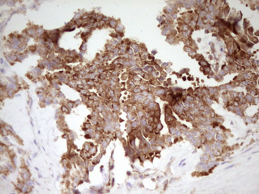 FARSB Antibody - Immunohistochemical staining of paraffin-embedded Human testicular cancer tissue using anti-FARSB mouse monoclonal antibody. (Heat-induced epitope retrieval by 1 mM EDTA in 10mM Tris, pH8.5, 120C for 3min,