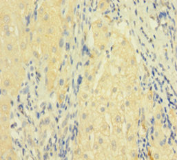 FASLG / Fas Ligand Antibody - Immunohistochemistry of paraffin-embedded human liver cancer using FASLG Antibody at dilution of 1:100