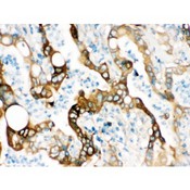 FASN / Fatty Acid Synthase Antibody - FASN was detected in paraffin-embedded sections of human intestinal cancer tissues using rabbit anti- FASN Antigen Affinity purified polyclonal antibody at 1 ug/mL. The immunohistochemical section was developed using SABC method.