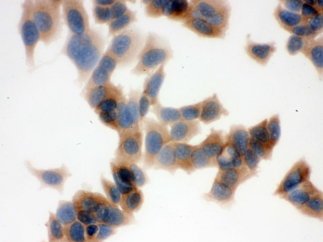 FASN / Fatty Acid Synthase Antibody - IHC analysis of FASN using anti-FASN antibody. FASN was detected in immunocytochemical section of MCF-7 cell. Heat mediated antigen retrieval was performed in citrate buffer (pH6, epitope retrieval solution) for 20 mins. The tissue section was blocked with 10% goat serum. The tissue section was then incubated with 1µg/ml rabbit anti-FASN Antibody overnight at 4°C. Biotinylated goat anti-rabbit IgG was used as secondary antibody and incubated for 30 minutes at 37°C. The tissue section was developed using Strepavidin-Biotin-Complex (SABC) with DAB as the chromogen.