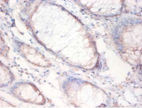 FASN / Fatty Acid Synthase Antibody - Immunohistochemistry of paraffin-embedded human colon cancer tissue using antibody at dilution 1:50.  This image was taken for the unconjugated form of this product. Other forms have not been tested.