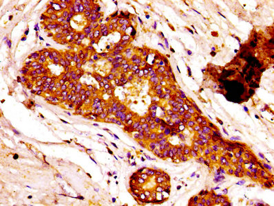 FASN / Fatty Acid Synthase Antibody - IHC image of FASN Antibody diluted at 1:100 and staining in paraffin-embedded human breast cancer performed on a Leica BondTM system. After dewaxing and hydration, antigen retrieval was mediated by high pressure in a citrate buffer (pH 6.0). Section was blocked with 10% normal goat serum 30min at RT. Then primary antibody (1% BSA) was incubated at 4°C overnight. The primary is detected by a biotinylated secondary antibody and visualized using an HRP conjugated SP system.