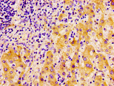 FASN / Fatty Acid Synthase Antibody - IHC image of FASN Antibody diluted at 1:100 and staining in paraffin-embedded human liver cancer performed on a Leica BondTM system. After dewaxing and hydration, antigen retrieval was mediated by high pressure in a citrate buffer (pH 6.0). Section was blocked with 10% normal goat serum 30min at RT. Then primary antibody (1% BSA) was incubated at 4°C overnight. The primary is detected by a biotinylated secondary antibody and visualized using an HRP conjugated ABC system.