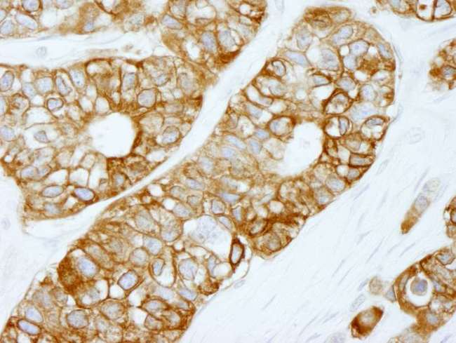 FASN / Fatty Acid Synthase Antibody - Detection of Human FASN by Immunohistochemistry. Sample: FFPE section of breast carcinoma. Antibody: Affinity purified rabbit anti-FASN used at a dilution of 1:250.
