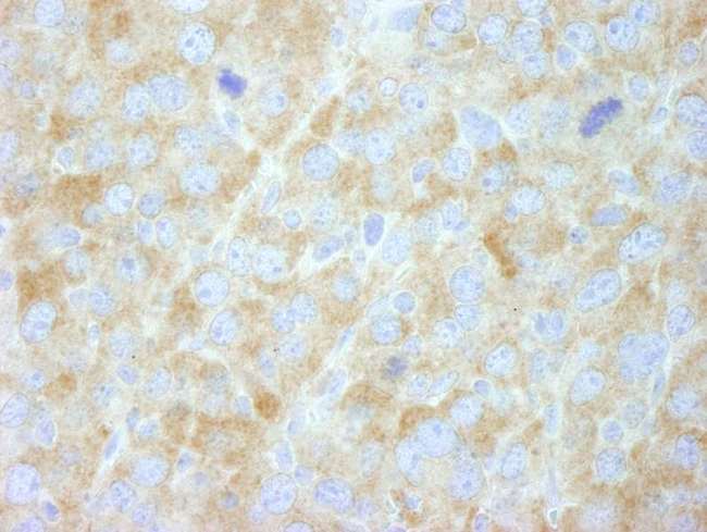 FASN / Fatty Acid Synthase Antibody - Detection of Mouse FASN by Immunohistochemistry. Sample: FFPE section of mouse renal cell carcinoma. Antibody: Affinity purified rabbit anti-FASN used at a dilution of 1:250.