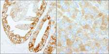 FASN / Fatty Acid Synthase Antibody - Detection of Human and Mouse FASN by Immunohistochemistry. Sample: FFPE section of human prostate carcinoma (left) and mouse renal cell carcinoma (right). Antibody: Affinity purified rabbit anti-FASN used at a dilution of 1:200 (1 Detection: DAB.
