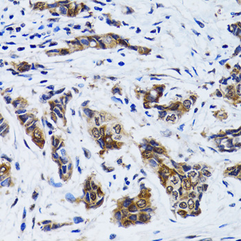 FASN / Fatty Acid Synthase Antibody - Immunohistochemistry of paraffin-embedded human breast cancer using FASN antibody at dilution of 1:100 (40x lens).