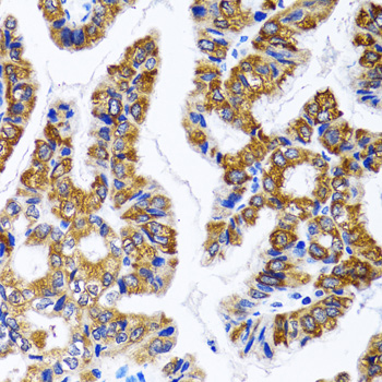 FASN / Fatty Acid Synthase Antibody - Immunohistochemistry of paraffin-embedded human gastric cancer using FASN antibody at dilution of 1:100 (40x lens).