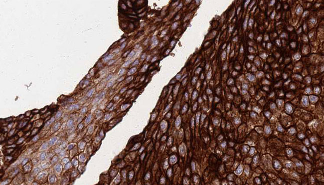 FASN / Fatty Acid Synthase Antibody - 1:100 staining human urothelial carcinoma tissue by IHC-P. The sample was formaldehyde fixed and a heat mediated antigen retrieval step in citrate buffer was performed. The sample was then blocked and incubated with the antibody for 1.5 hours at 22°C. An HRP conjugated goat anti-rabbit antibody was used as the secondary.