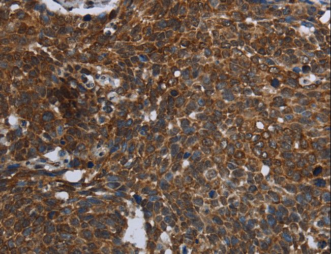 FASTKD2 Antibody - Immunohistochemistry of paraffin-embedded Human cervical cancer using FASTKD2 Polyclonal Antibody at dilution of 1:45.