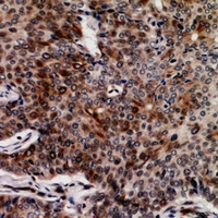 FASTKD3 Antibody - Immunohistochemical analysis of FASTKD3 staining in human breast cancer formalin fixed paraffin embedded tissue section. The section was pre-treated using heat mediated antigen retrieval with sodium citrate buffer (pH 6.0). The section was then incubated with the antibody at room temperature and detected using an HRP conjugated compact polymer system. DAB was used as the chromogen. The section was then counterstained with haematoxylin and mounted with DPX.