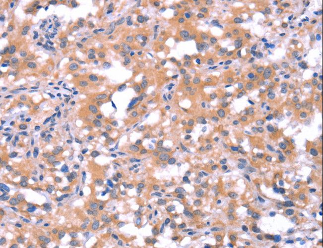 FAT1 / FAT Antibody - Immunohistochemistry of paraffin-embedded Human thyroid cancer using FAT1 Polyclonal Antibody at dilution of 1:40.