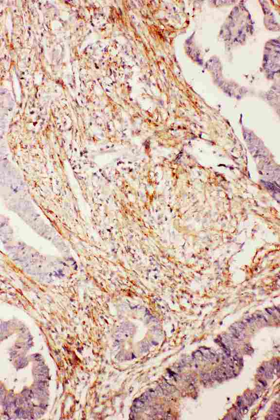 FAT10 / UBD Antibody - Anti-Diubiquitin antibody, IHC(P): Human Intestinal Cancer Tissue