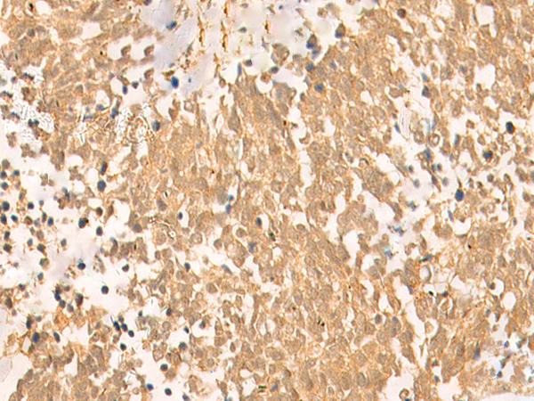 FAT10 / UBD Antibody - Immunohistochemistry of paraffin-embedded Human lung cancer tissue  using UBD Polyclonal Antibody at dilution of 1:50(×200)