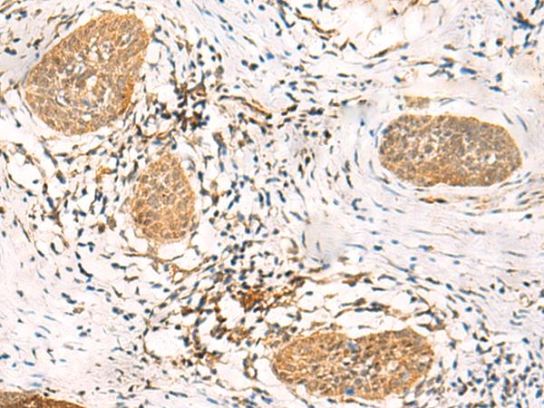 FAT10 / UBD Antibody - Immunohistochemistry of paraffin-embedded Human esophagus cancer tissue  using UBD Polyclonal Antibody at dilution of 1:50(×200)