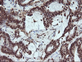 FATE1 Antibody - IHC of paraffin-embedded Adenocarcinoma of Human colon tissue using anti-FATE1 mouse monoclonal antibody.