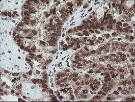 FATE1 Antibody - IHC of paraffin-embedded Adenocarcinoma of Human ovary tissue using anti-FATE1 mouse monoclonal antibody.