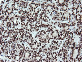 FATE1 Antibody - IHC of paraffin-embedded Carcinoma of Human thyroid tissue using anti-FATE1 mouse monoclonal antibody.