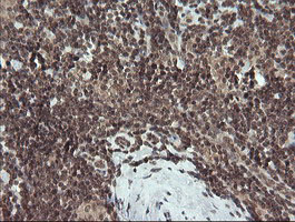 FATE1 Antibody - IHC of paraffin-embedded Human lymphoma tissue using anti-FATE1 mouse monoclonal antibody.