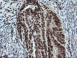 FATE1 Antibody - IHC of paraffin-embedded Adenocarcinoma of Human endometrium tissue using anti-FATE1 mouse monoclonal antibody.