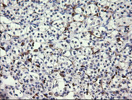 FATE1 Antibody - IHC of paraffin-embedded Carcinoma of Human kidney tissue using anti-FATE1 mouse monoclonal antibody.