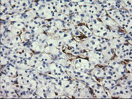 FATE1 Antibody - IHC of paraffin-embedded Carcinoma of Human kidney tissue using anti-FATE1 mouse monoclonal antibody.