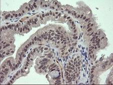 FATE1 Antibody - Immunohistochemical staining of paraffin-embedded Adenocarcinoma of Human ovary tissue using anti-FATE1 mouse monoclonal antibody. (Heat-induced epitope retrieval by 10mM citric buffer, pH6.0, 120C for 3min,