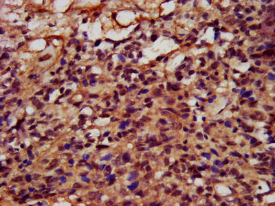 FATE1 Antibody - IHC image of FATE1 Antibody diluted at 1:400 and staining in paraffin-embedded human ovarian cancer performed on a Leica BondTM system. After dewaxing and hydration, antigen retrieval was mediated by high pressure in a citrate buffer (pH 6.0). Section was blocked with 10% normal goat serum 30min at RT. Then primary antibody (1% BSA) was incubated at 4°C overnight. The primary is detected by a biotinylated secondary antibody and visualized using an HRP conjugated SP system.