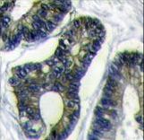 FAU / Fub1 Antibody - Formalin-fixed and paraffin-embedded human colon carcinoma reacted with FUBI Antibody , which was peroxidase-conjugated to the secondary antibody, followed by DAB staining. This data demonstrates the use of this antibody for immunohistochemistry; clinical relevance has not been evaluated.