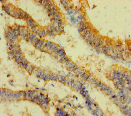 FAU / Fub1 Antibody - Immunohistochemistry of paraffin-embedded human endometrial cancer at dilution of 1:100