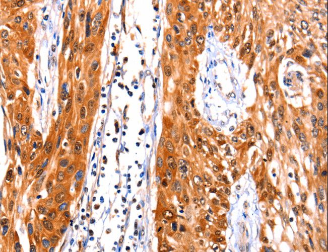 FBLN1 / Fibulin 1 Antibody - Immunohistochemistry of paraffin-embedded Human liver cancer using FBLN1 Polyclonal Antibody at dilution of 1:47.