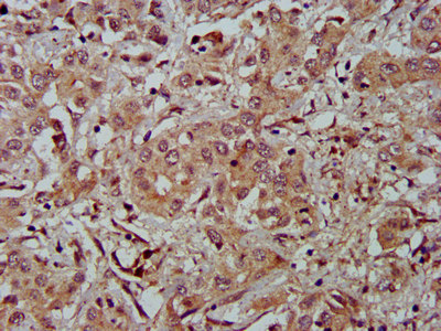 FBLN2 / Fibulin 2 Antibody - Immunohistochemistry image at a dilution of 1:500 and staining in paraffin-embedded human liver cancer performed on a Leica BondTM system. After dewaxing and hydration, antigen retrieval was mediated by high pressure in a citrate buffer (pH 6.0) . Section was blocked with 10% normal goat serum 30min at RT. Then primary antibody (1% BSA) was incubated at 4 °C overnight. The primary is detected by a biotinylated secondary antibody and visualized using an HRP conjugated SP system.