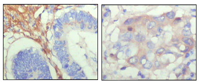 FBLN5 / Fibulin 5 Antibody - IHC of paraffin-embedded human colon cancer (left) and breast cancer (right) showing cytoplasmic localization with DAB staining using FBLN5 mouse monoclonal antibody.