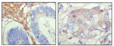FBLN5 / Fibulin 5 Antibody - IHC of paraffin-embedded human colon cancer (left) and breast cancer (right) showing cytoplasmic localization with DAB staining using FBLN5 mouse monoclonal antibody.