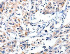 FBLN5 / Fibulin 5 Antibody - Immunohistochemistry of paraffin-embedded Human lung cancer using FBLN5 Polyclonal Antibody at dilution of 1:85.