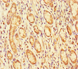 FBLN7 / Fibulin 7 Antibody - Immunohistochemistry of paraffin-embedded human gastric cancer using FBLN7 Antibody at dilution of 1:100