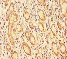 FBLN7 / Fibulin 7 Antibody - Immunohistochemistry of paraffin-embedded human gastric cancer using FBLN7 Antibody at dilution of 1:100
