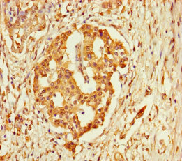 FBLN7 / Fibulin 7 Antibody - Immunohistochemistry of paraffin-embedded human pancreatic cancer using FBLN7 Antibody at dilution of 1:100