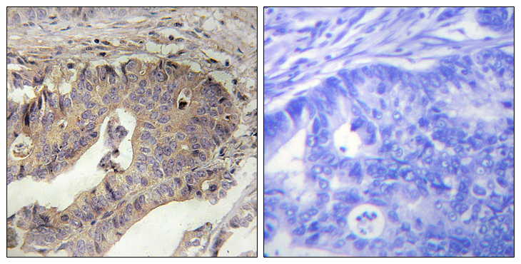 FBN1 / Fibrillin 1 Antibody - Immunohistochemistry analysis of paraffin-embedded human breast carcinoma tissue, using Fibrillin-1 Antibody. The picture on the right is blocked with the synthesized peptide.