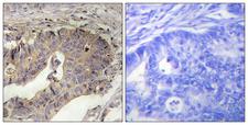 FBN1 / Fibrillin 1 Antibody - Immunohistochemistry analysis of paraffin-embedded human breast carcinoma tissue, using Fibrillin-1 Antibody. The picture on the right is blocked with the synthesized peptide.