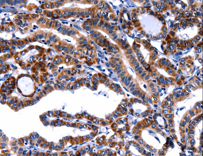 FBN1 / Fibrillin 1 Antibody - Immunohistochemistry of paraffin-embedded Human thyroid cancer using FBN1 Polyclonal Antibody at dilution of 1:40.