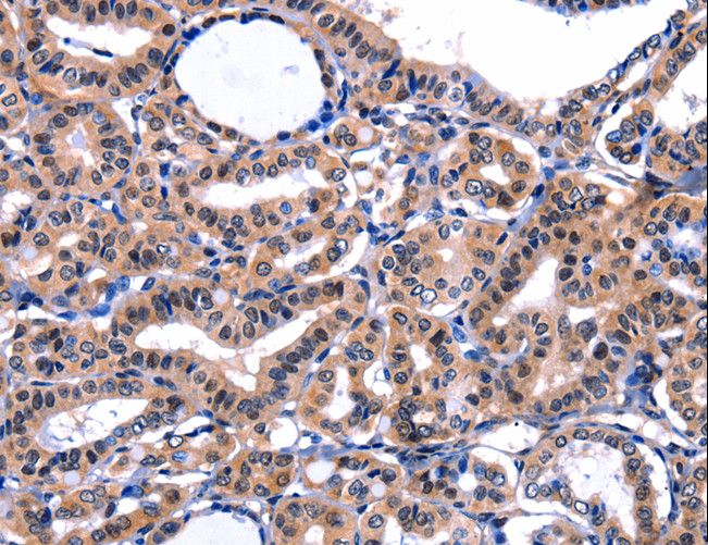 FBN1 / Fibrillin 1 Antibody - Immunohistochemistry of paraffin-embedded Human thyroid cancer using FBN1 Polyclonal Antibody at dilution of 1:47.